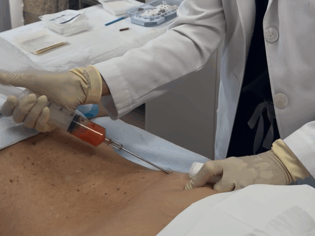 stem cell therapy in newport beach ca